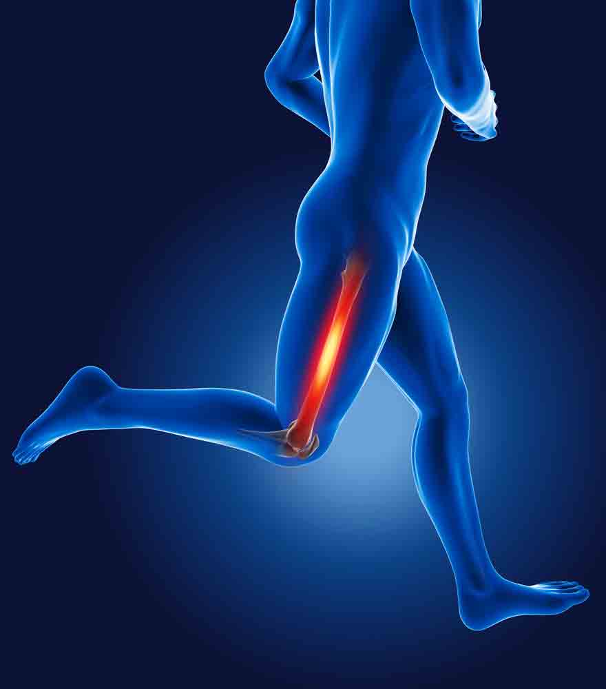 Managing IT Band Friction Syndrome