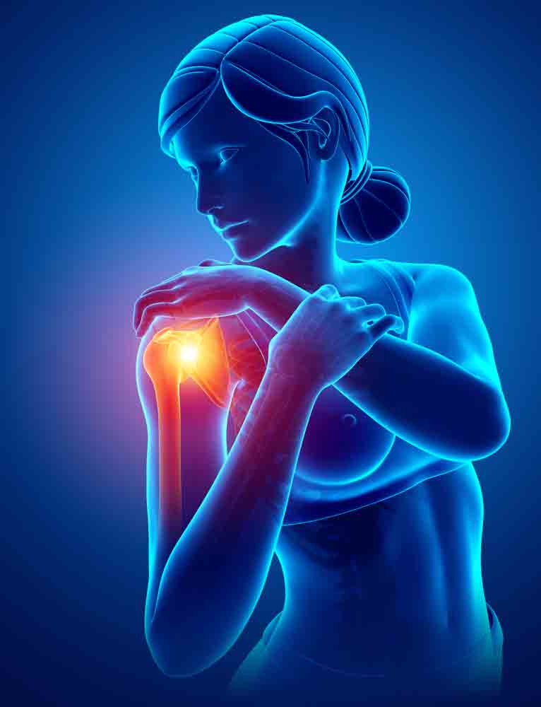 Understanding Shoulder Impingement Syndrome