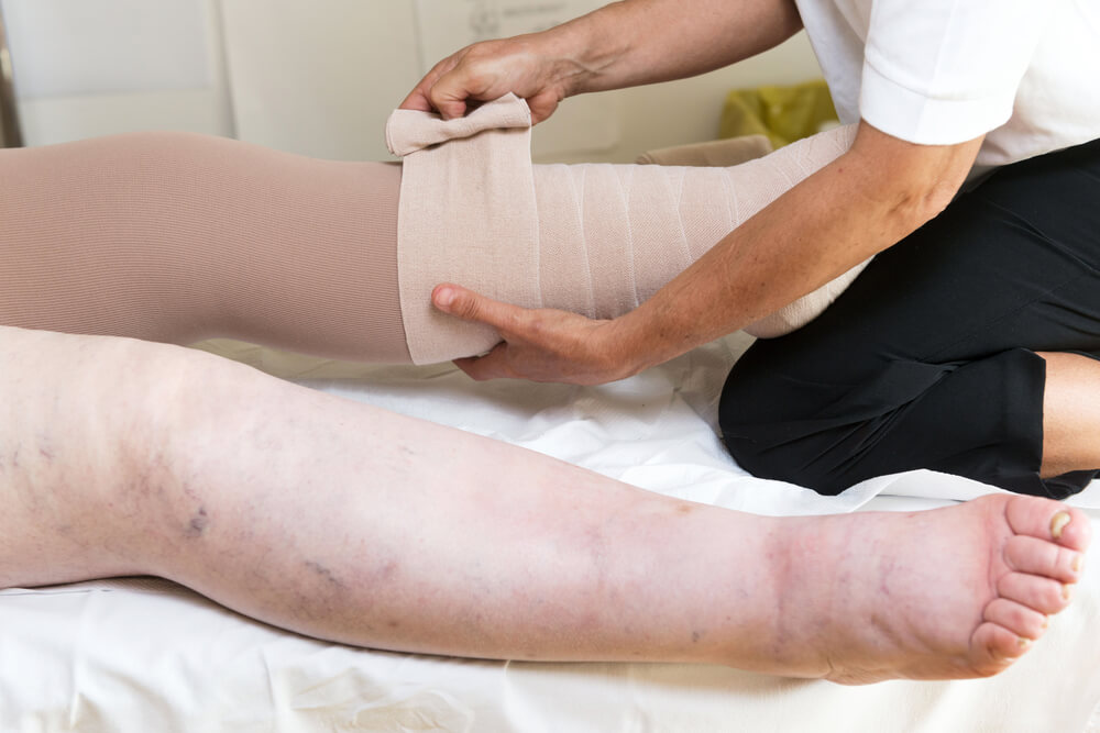 Understanding how lymphedema therapy can help your quality of life lymphedema therapy treatment options Understanding how lymphedema therapy can help your quality of life