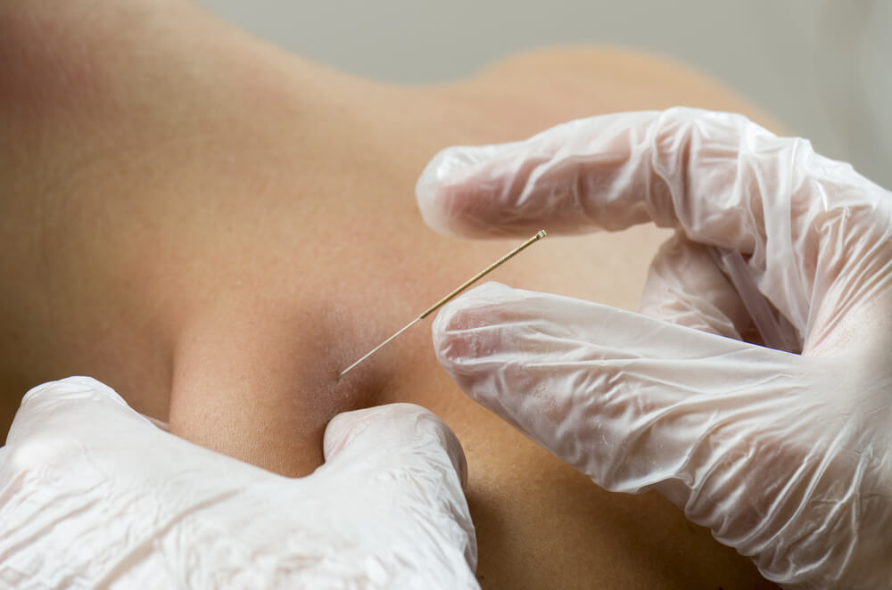 Visit a physical therapist in Grand Rapids, MI, for dry needling