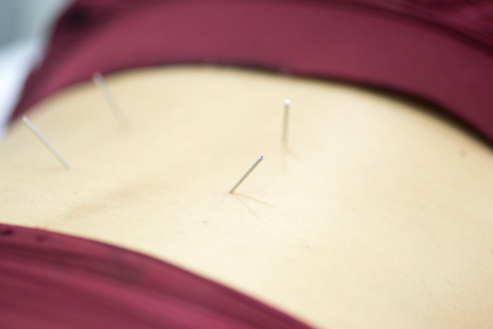 Why is my physical therapist talking about using dry needling for my sciatica?